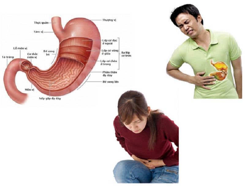 Những biểu hiện của đau dạ dày, đau thượng vị dạ dày