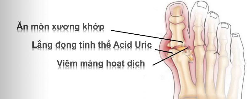 Giảm acid uric để chữa khỏi bệnh gút