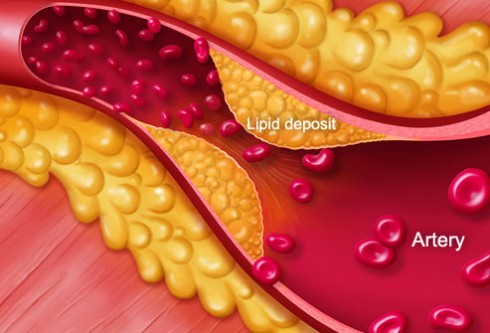 Hình ảnh minh họa rối loạn lipid máu