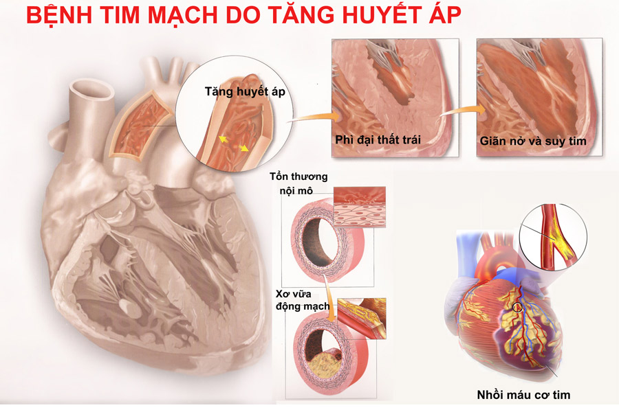 Tăng huyết áp biến chứng tim mạch