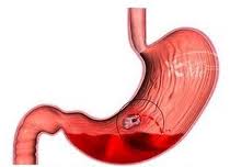 triệu chứng của xuất huyết dạ dày