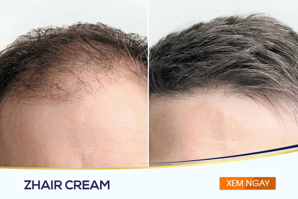 Người dùng trước và sau khi sử dụng sản phẩm Zhair Cream